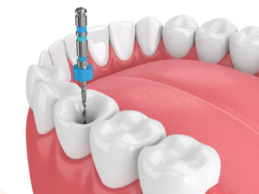 Điều trị chuyên sâu kỹ thuật cao
